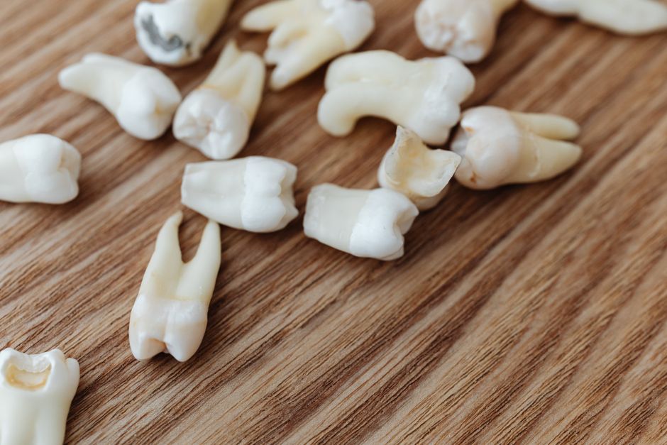 Modelo dental usado para explicar a cárie