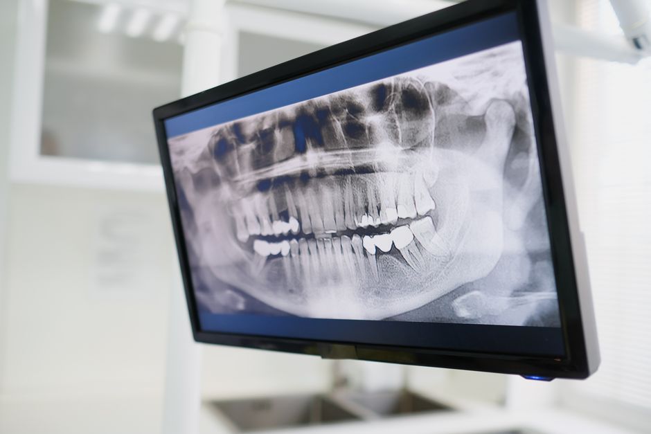 Radiografia do osso da mandíbula