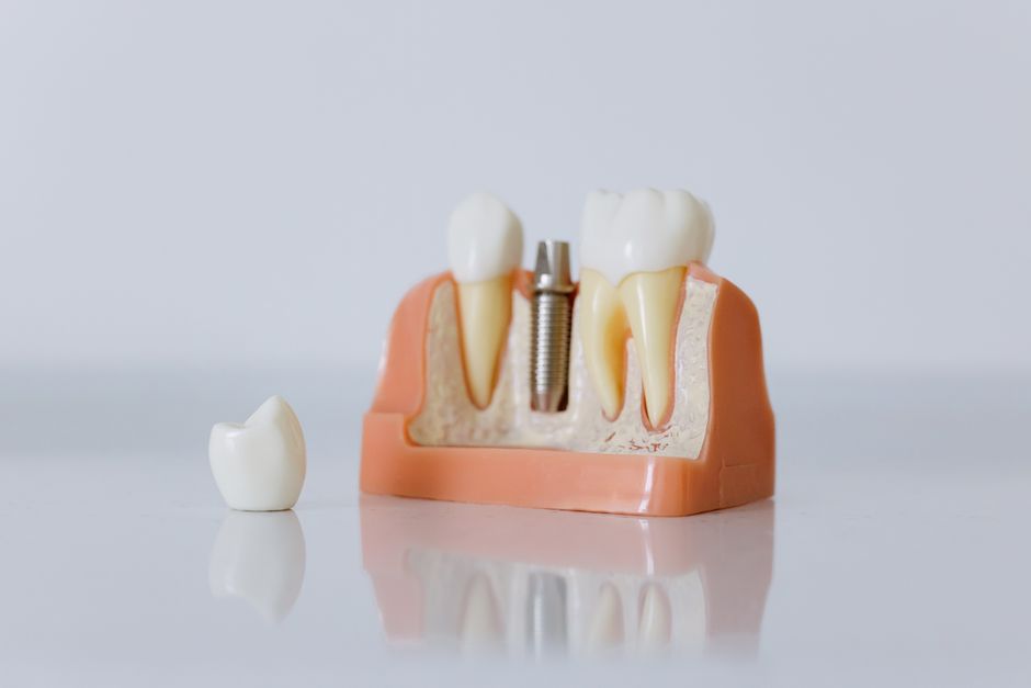 Modelo de implante dentário substituindo um dente
